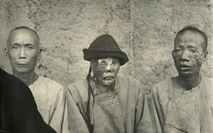 Individuals disfigured by leprosy